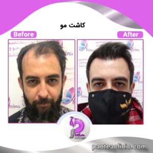 سن مناسب برای کاشت موی طبیعی