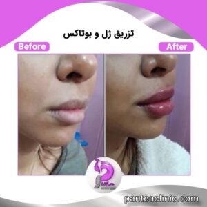 تزریق فیلر در کلینیک پانته آ