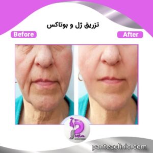 آشنایی با انواع فیلرهای پوستی