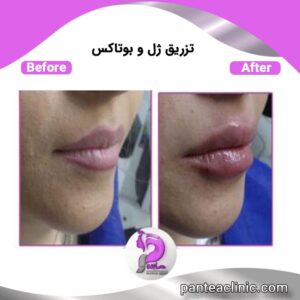 فیلر چیست؟