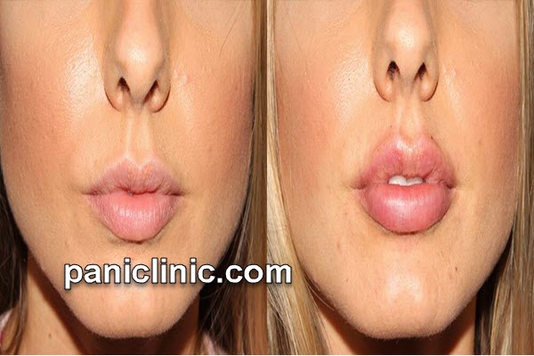 دکتر خوب برای تزریق فیلر لب در تهران | پانی کلینیک