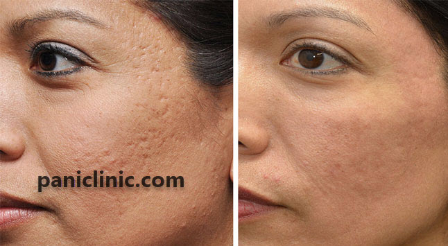 سابسیژن | پانی کلینیک