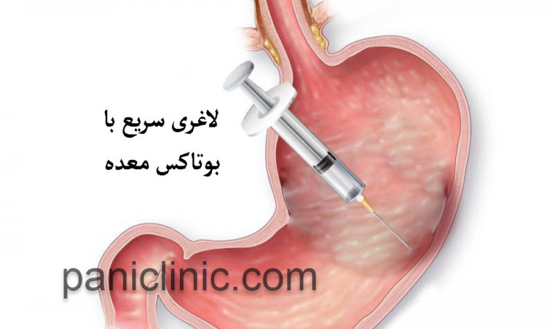 بوتاکس معده | کلینیک پانی