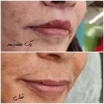 سانترال و لیفت لب