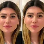 lip filer