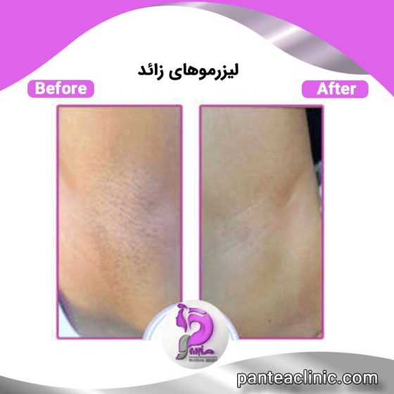 بهترین روش لیزر موی زائد