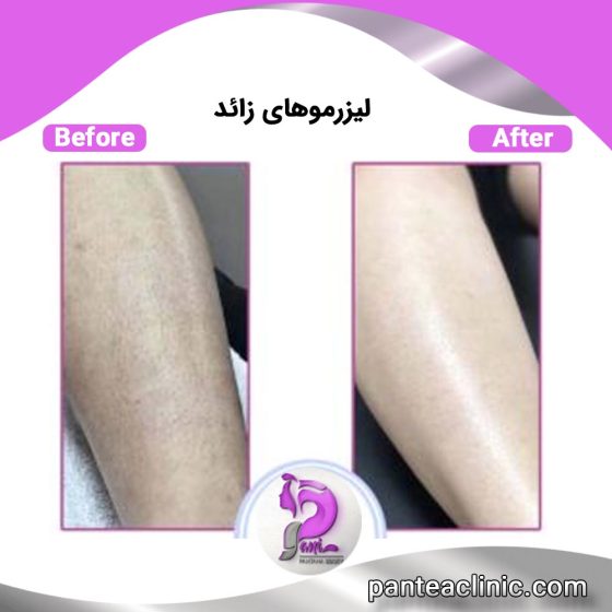 جدیدترین روش لیزر موی زائد