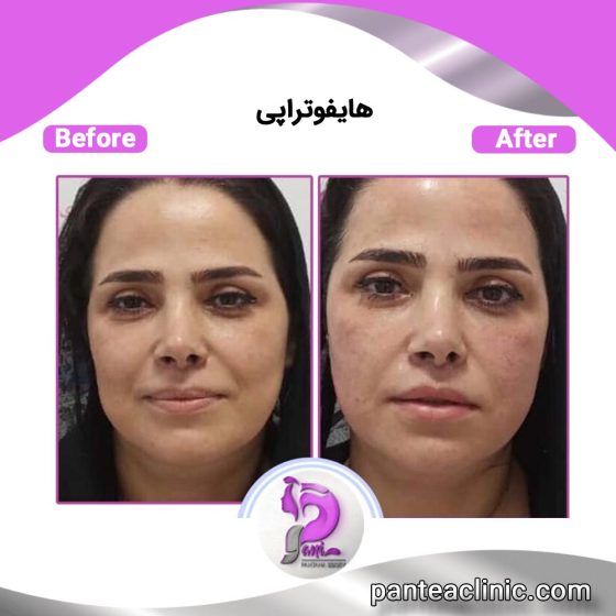 هایفو صورت