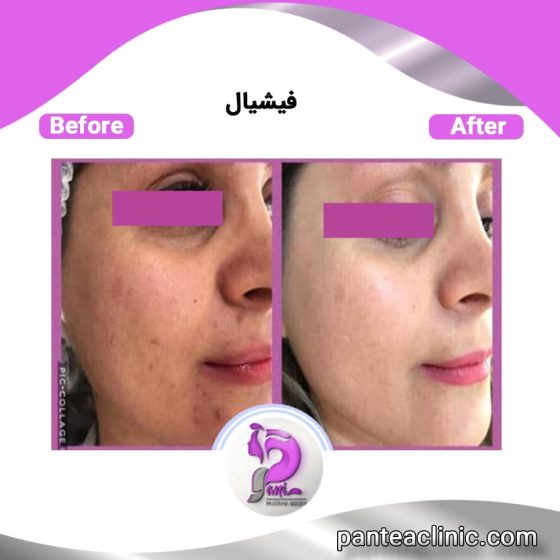 مزابای فیشیال صورت