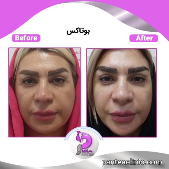 بوتاکس طبیعی