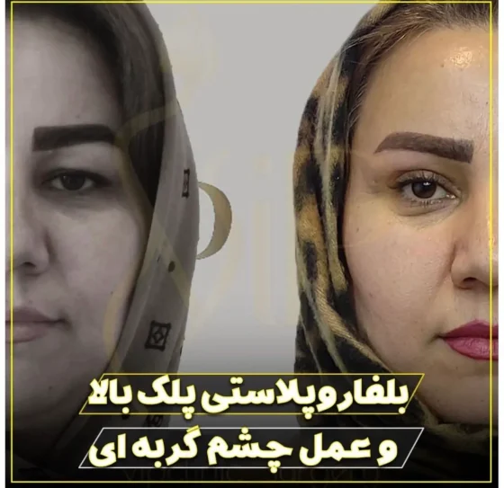 بلفاروپلاستی پلک بالا و عمل چشم گربه ای