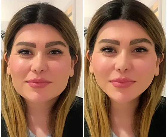 lip filer